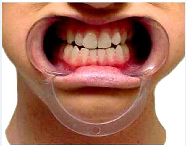 mouth with cheek retractor