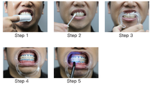 Load image into Gallery viewer, how to do teeth whitening