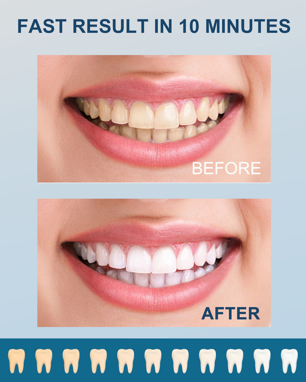 MySmile Premium Home Teeth Whitening Kit