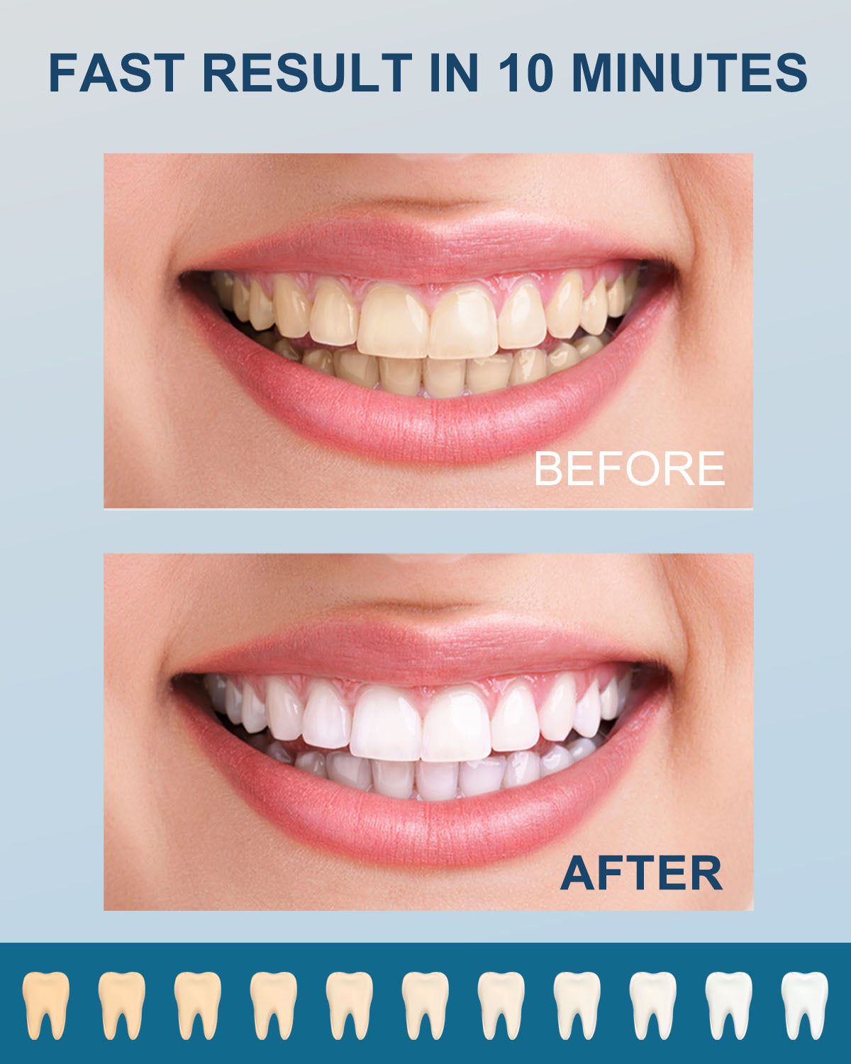 MySmile Premium Home Teeth Whitening Kit