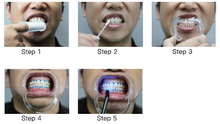 Load image into Gallery viewer, how to do teeth whitening
